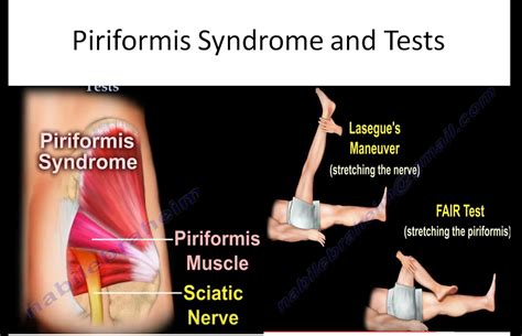 Piriformis syndrome (PS) is an example of extra-spinal sciatica that is often confused with spinal sciatica (prolapsed lumbar intervertebral disc), which makes diagnosis and treatment delay. ... The test is performed in supine position, keeping affected hip flexed at 60° and knee flexed at 90° followed by internal rotation and adduction of ...